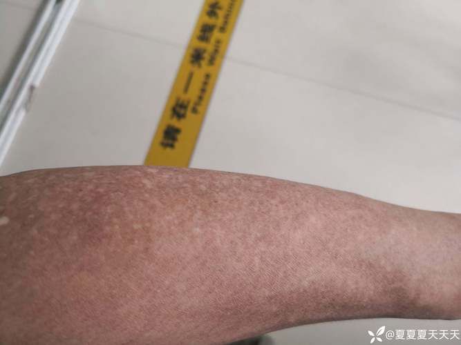 都匀市今日阳性感染者曲线图表/都匀确诊病例
