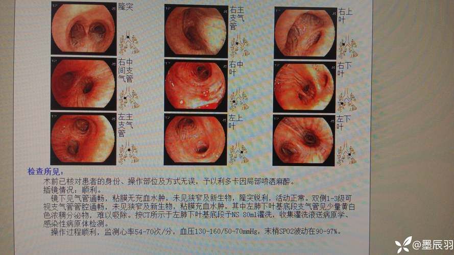 晋江现有无症状感染者14例(晋江新增2例)