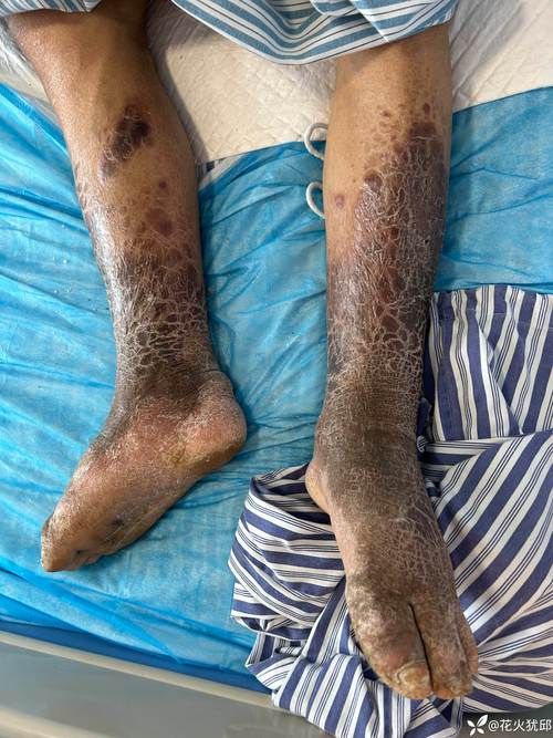 水磨沟区近3天新增12例重症_水磨沟区近3天新增12例重症病人