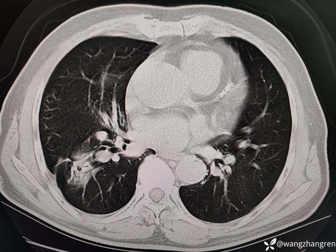 江西吉安永新县累计报告重症14例_江西吉安永新新型肺炎