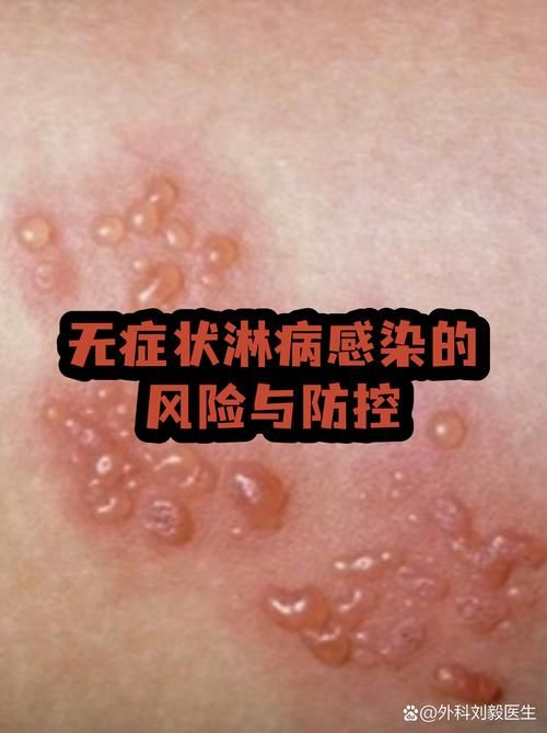 31省新增20例无症状感染者及17例无症状:31省新增2例无症状患者