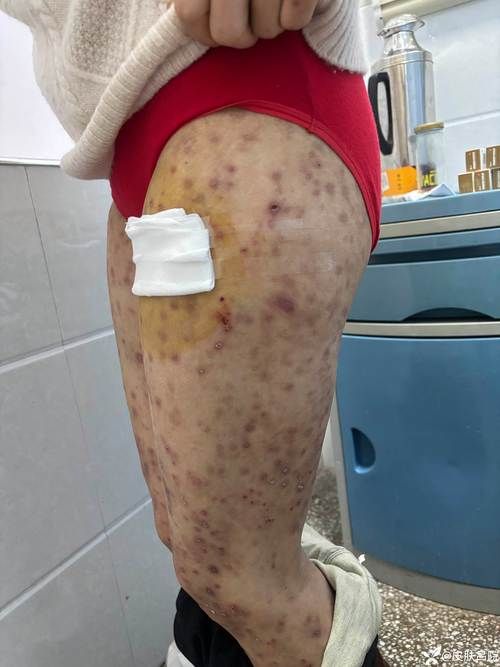 江西南昌东湖区近期新增感染趋势蔓延_南昌最新感染者